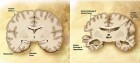 Alzheimer's disease brain comparison (credit: Wikimedia Commons)