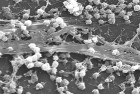 Magnetic Nanoparticles Combat Biofilms, A Source Of Chr...
