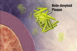 Illustration of formation of beta-amyloid plaques. Enzymes act on the APP (amyloid precursor protein) and cut it into fragments. The beta-amyloid fragment is crucial in the formation of senile plaques in Alzheimer’s disease. (credit: National Institute on Aging/NIH)