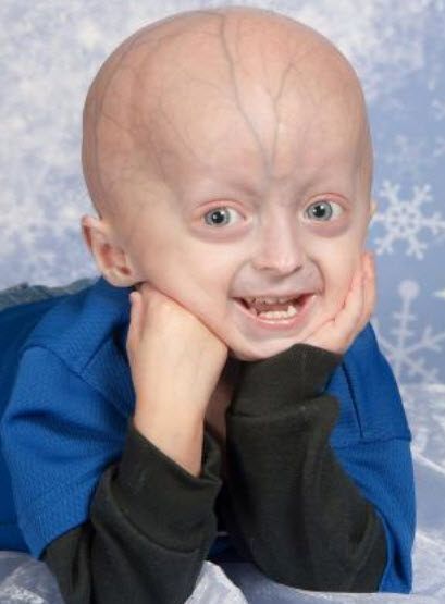 progeria people