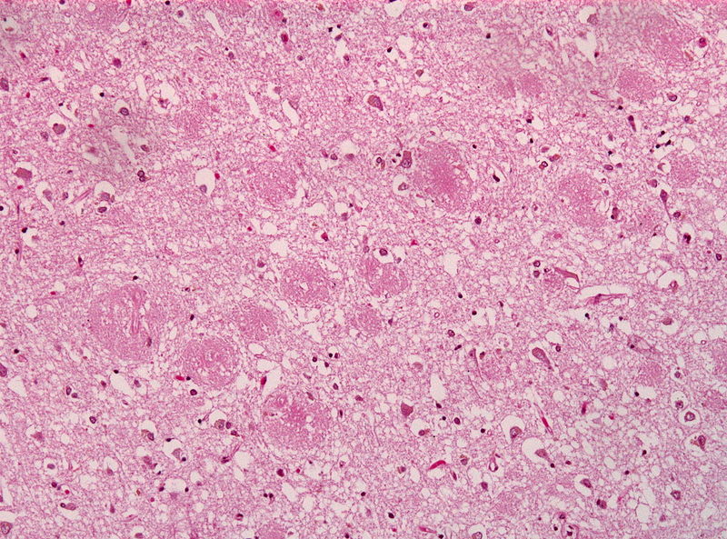 Amyloid_plaques_alzheimer_disease_HE_stain