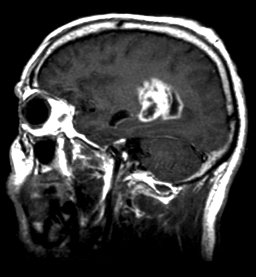 GBM MRI Scan