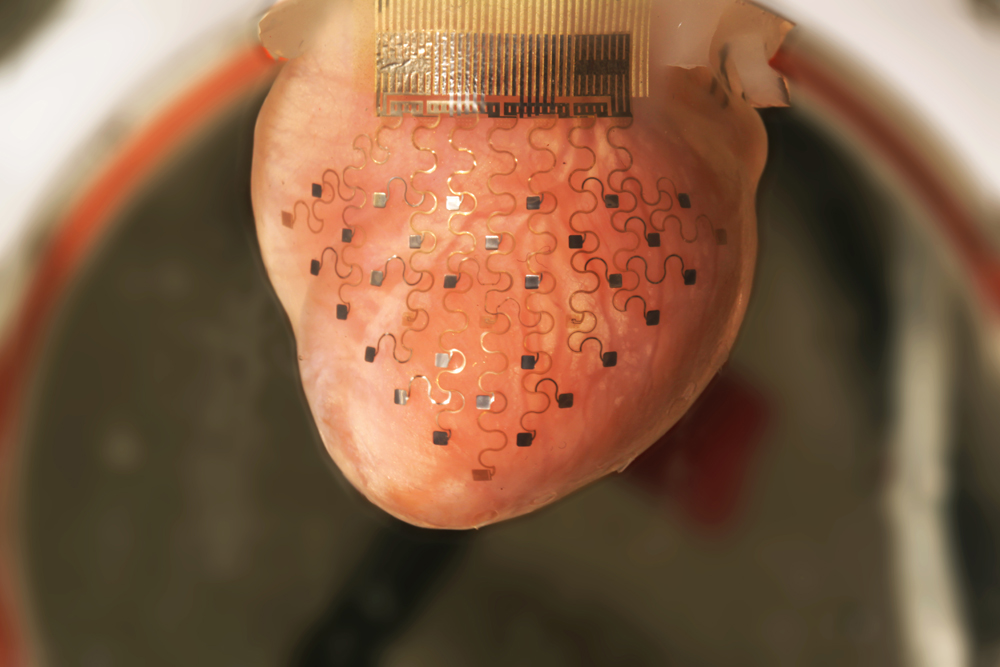 3D printer creates hi-res implantable device for customized heart treatment «  Kurzweil