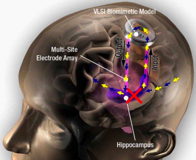 Hippocampal prosthesis restores memory functions by creating “MIMO” model-based electrical stimulation of the hippocampus --- bypassing a damaged brain region (red X). (credit: USC)