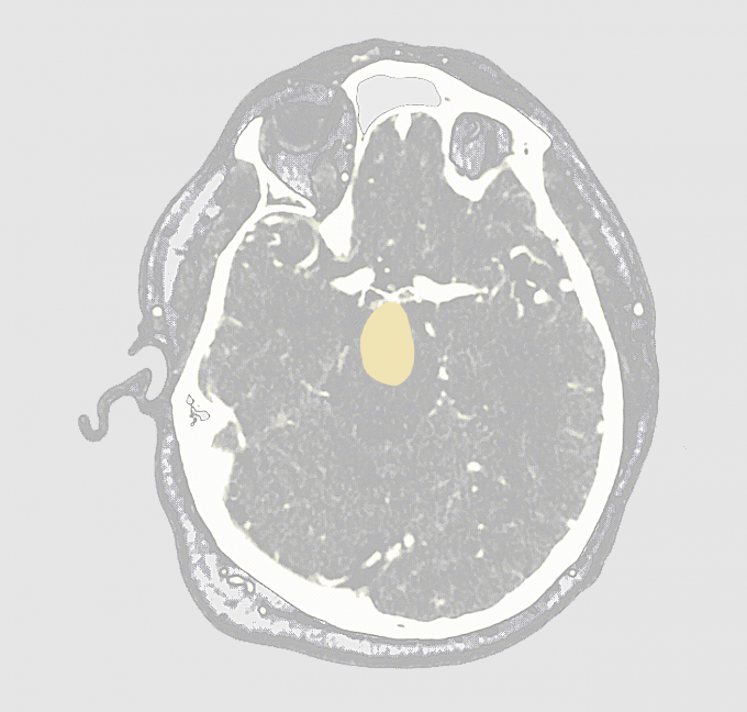 photo - brain scan + aneurysm - no. 2